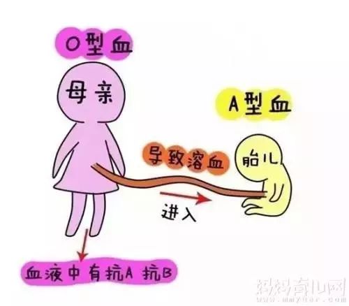 双o血型父母还会得溶血症吗