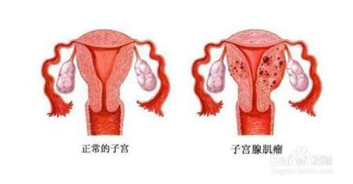 子宫肌瘤手术费用大概多少