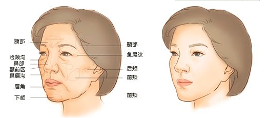 自体脂肪填充泪沟能保持几年