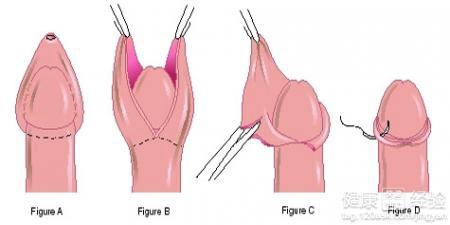 割包皮手术要多长时间