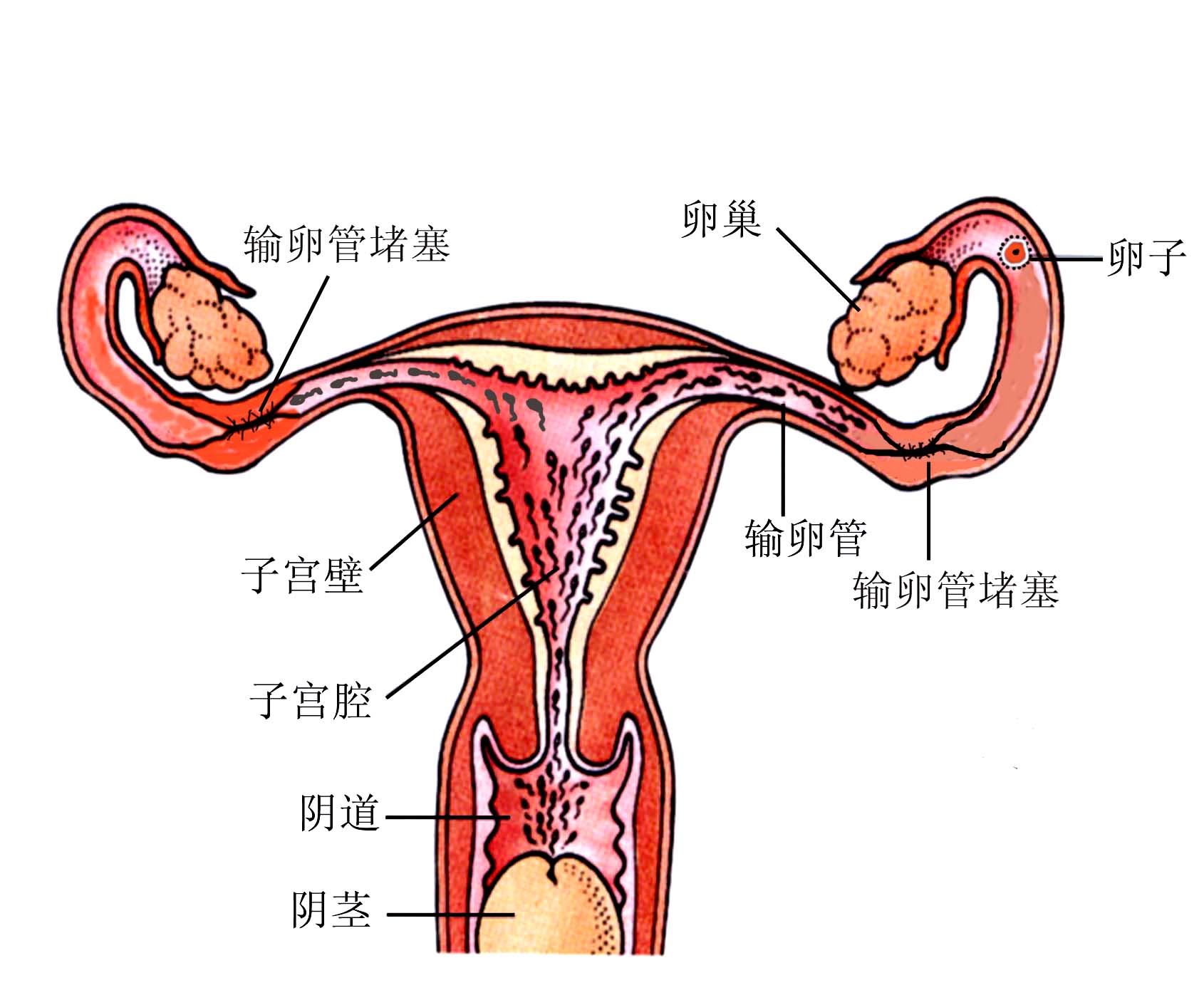 输卵管有积液会影响怀孕吗