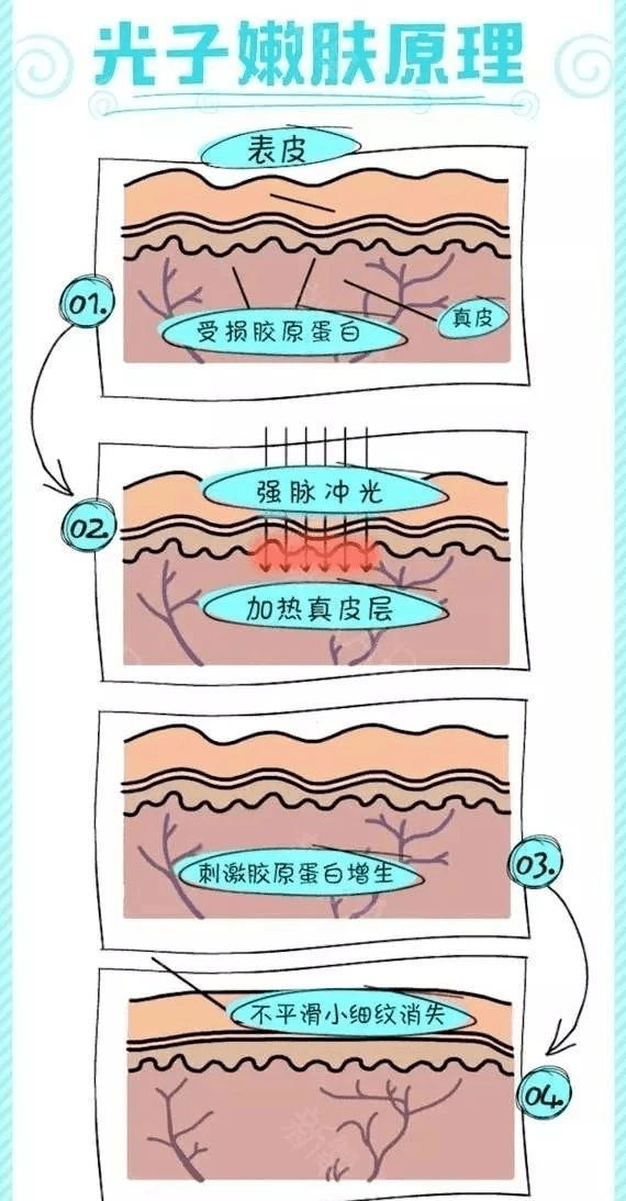 光子嫩肤原理图,光子嫩肤原理图深度解析及持续执行策略探讨,优选方案解析说明_XT30.49.23