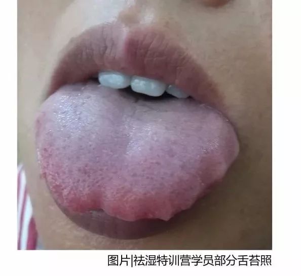 舌头两边锯齿状是什么原因