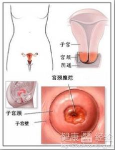 治疗子宫肌瘤的偏方