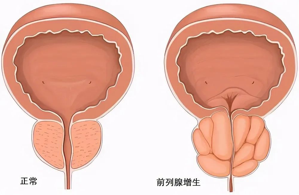 前列腺病有什么症状表现