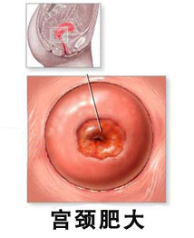 宫颈肥大糜烂怎么治疗