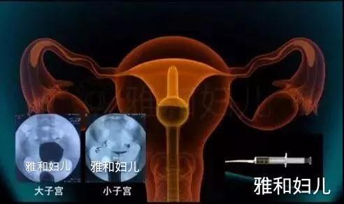 输卵管起因的女性不孕症