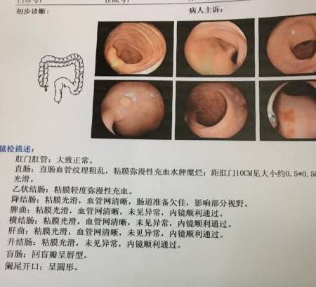 盆腔炎最明显的三种征兆肠道有息肉