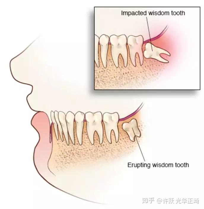 牙髓炎怎么止疼最快